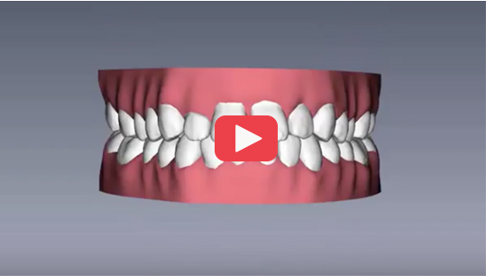 Straight Your Teeth With Clear Aligners